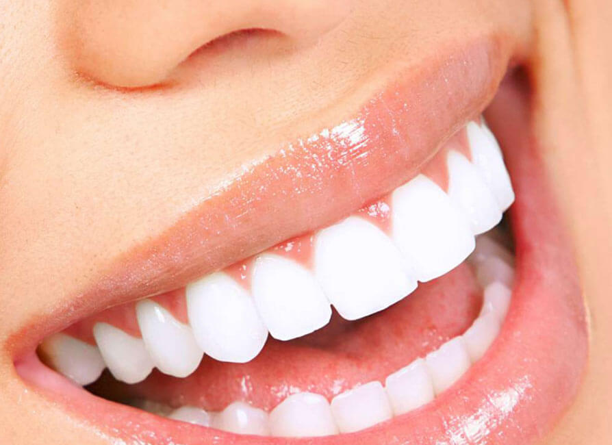 Composite Esthetic Fillings Service