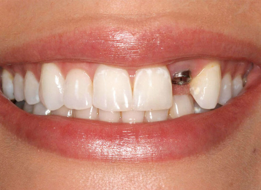 Conventional Implants