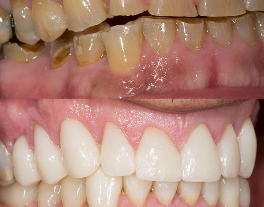 Full Mouth Reconstruction Service