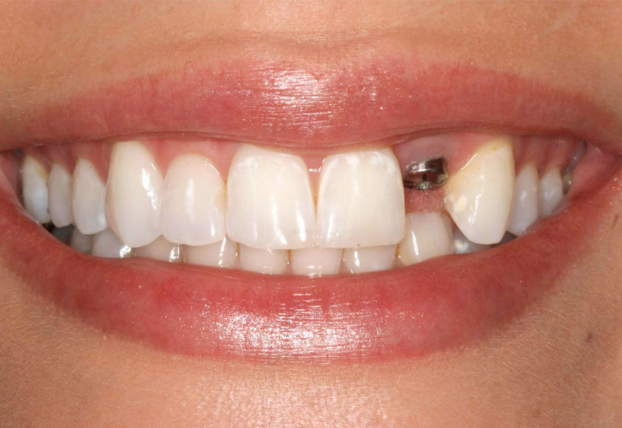 Mini Implants Service